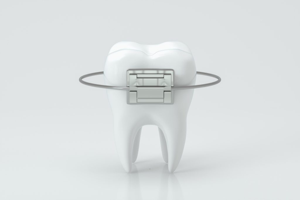 3D model of a tooth fitted with a dental crown
